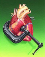 Hipertensi�n arterial
