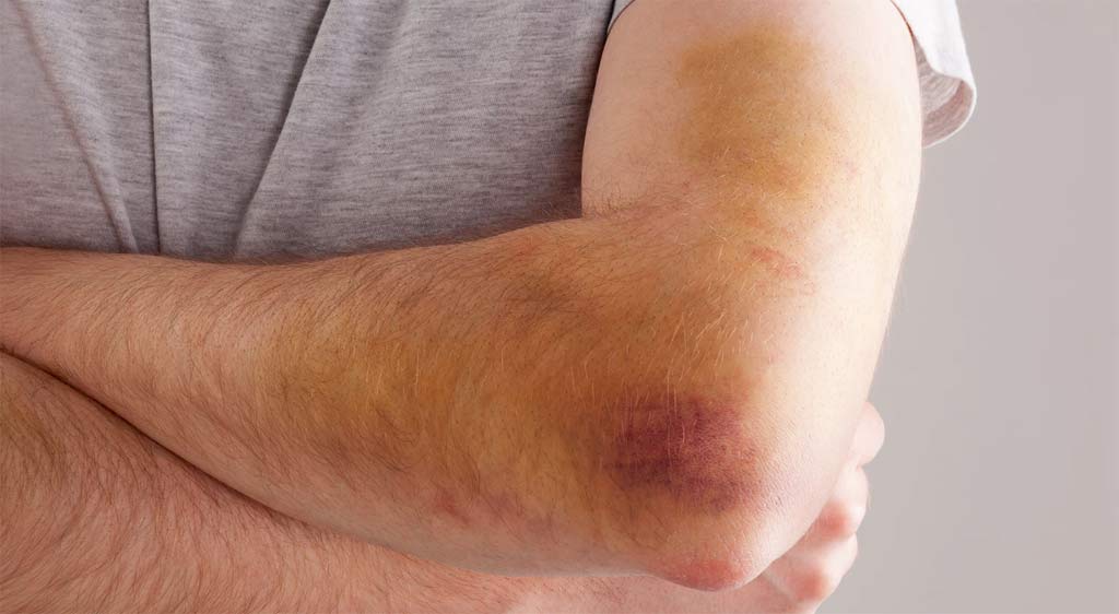 golpes hematomas tratamiento